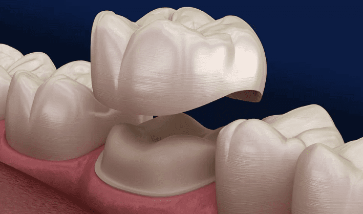 치아 크라운 종류